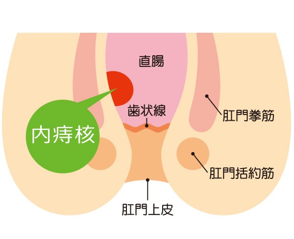 内核痔