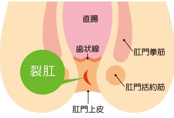 切れ痔